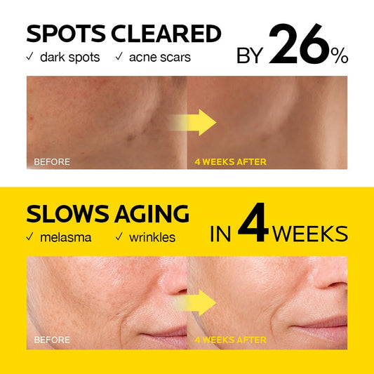 MIMUMIMU Dark Spot Remover Serum for Face | Korean Clinic Skincare - Thioctic Acid 0.01% & Niacinamide 5% | Spot Treatment for Melasma, Hyperpigmentation, Discoloration, Acne Scars | 30ml/1.01 fl.oz