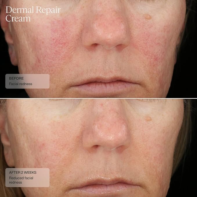 Senté Dermal Repair Facial Cream | Nourishing for Rosacea & Sensitive Skin | Hydrate & Rejuvenate | with Patented HSA, Vitamin E & Green Tea Extract - 1.7 Fl Oz