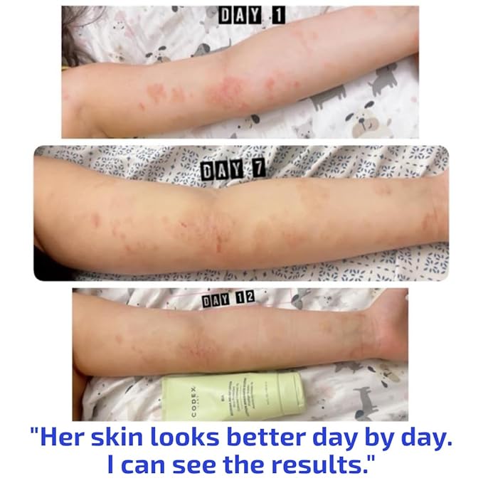 BIA Eczema Relief Lotion, 3.4 oz - Clinically Proven Colloidal Oatmeal 1% for Itchy Dry Eczema Prone Skin - Fragrance Free Moisturizer with BiaComplex 2.0 - Safe for Babies, Kids & Adults
