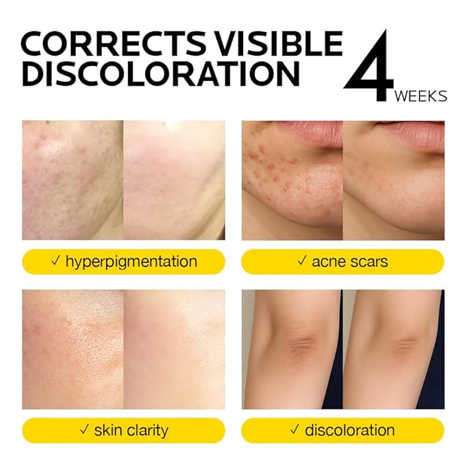 MIMUMIMU Dark Spot Remover for Face | Korean Clinic Skincare - Thioctic Acid 0.01% & Niacinamide 10% | Overnight Treatment for Melasma, Hyperpigmentation, Discoloration, Acne Scars | Pack of 2