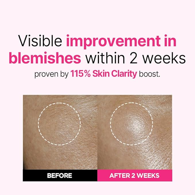 ISOI Blemish Care Up Serum for Face, Vegan Hydrating Serum for Smooth & Glass Skin Effect, Skin Barrier & Moisture Balance for Women, Korean Skin Care (1.18 fl. oz, 35ml)