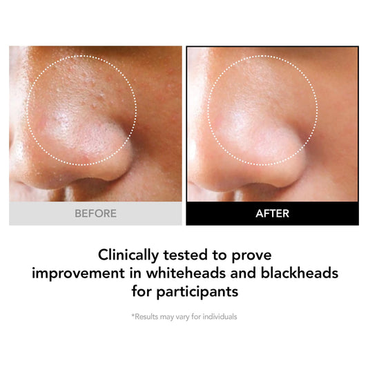 KIOSKIN 98% Reduction in Pore Impurities & 92% Less Sebum – Improves Blackheads & Whiteheads by 36% – Soothes & Strengthens Skin Barrier with D-Panthenol – Korean Skincare Best Cleansing Foam