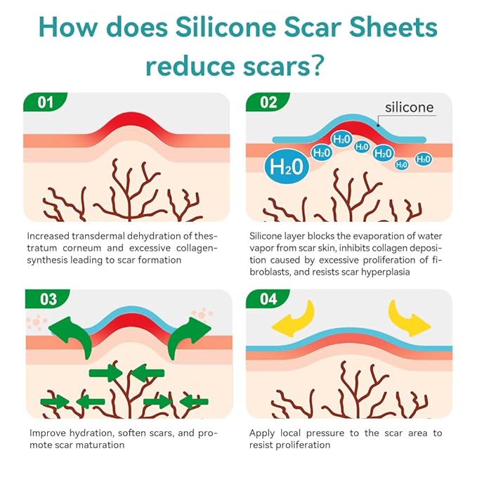 Dimora Medical Grade Silicone Scar Sheets - Ultra Soft Silicone Scar Tape (1.6”x120" Roll), Waterproof Scar Treatment for Surgical Scars, C Section, Tummy Tuck, Keloid Treatment
