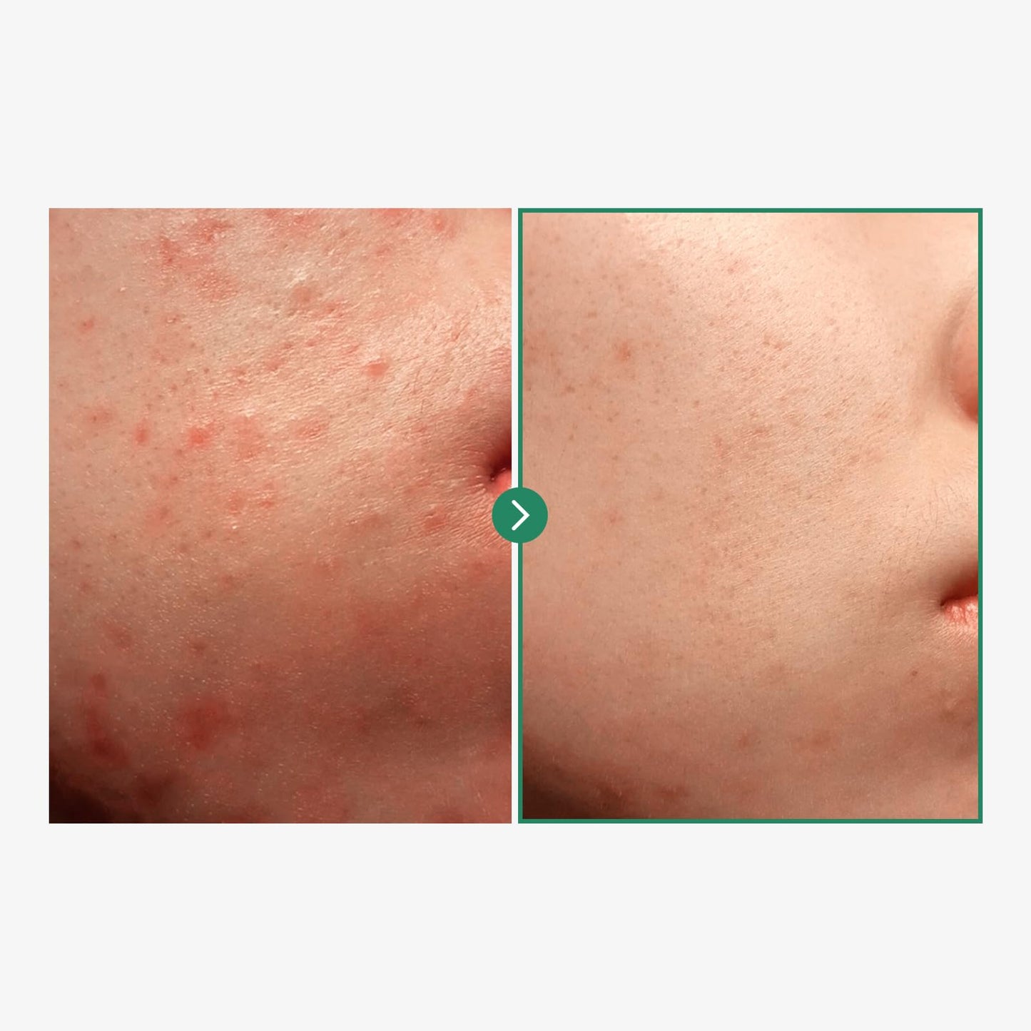 NATUREONE BHA Acne Foam Cleansing, Acne Face Wash, Salicylic Acid for Acne Prone Skin, Exfoliator, Sebum, Blackhead Remover and Dead Cells, Foaming Pore Cleanser, Korean Skincare, 100ml, 3.38 fl.oz.