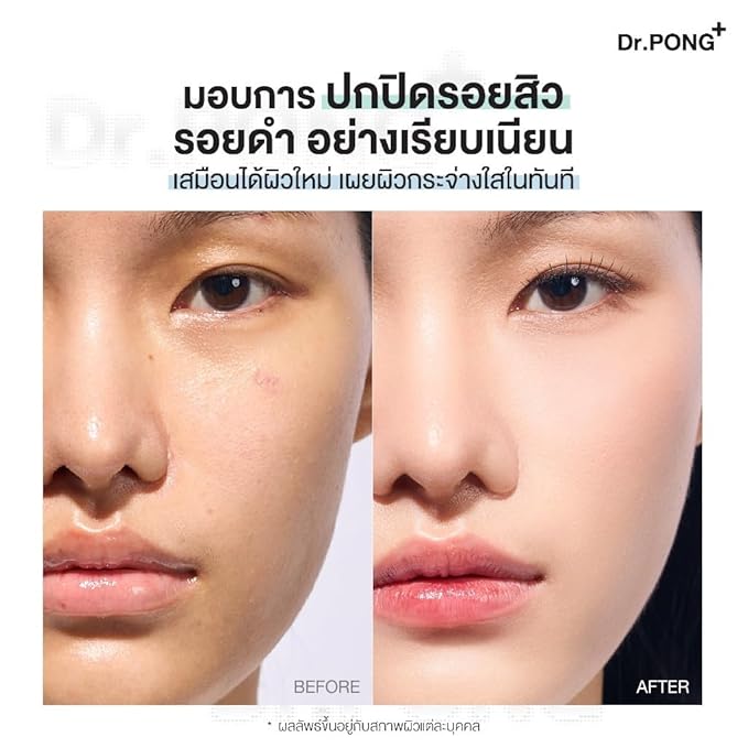 Dr.PONG ACNE ACE Longwear Cushion (Light, 15) 15g