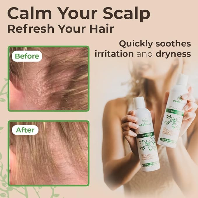 Eczema Psoriasis Conditioner and Dry Scalp Treatment - Anti Dandruff Hair Conditioner for Damaged Dry Hair - Scalp Psoriasis - Deep Conditioner for Seborrheic Dermatitis Scalp - Dry Scalp Conditioner