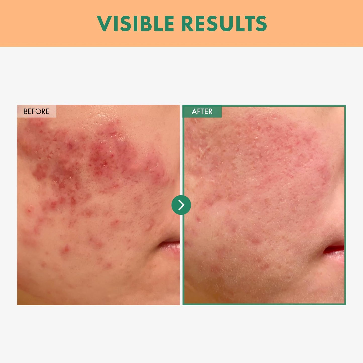 NATUREONE BHA Acne Foam Cleansing, Acne Face Wash, Salicylic Acid for Acne Prone Skin, Exfoliator, Sebum, Blackhead Remover and Dead Cells, Foaming Pore Cleanser, Korean Skincare, 100ml, 3.38 fl.oz.