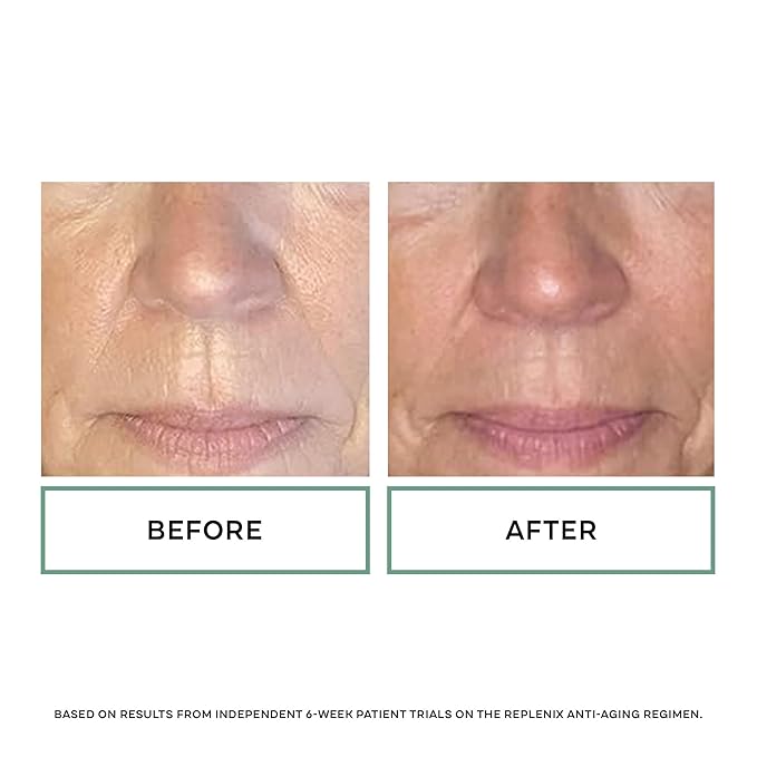 Replenix Glycolic Acid 20% Resurfacing Cream, Hydrating & Lightweight Medical-Grade Exfoliating Face Moisturizer for Skin Discoloration (1.7 oz)