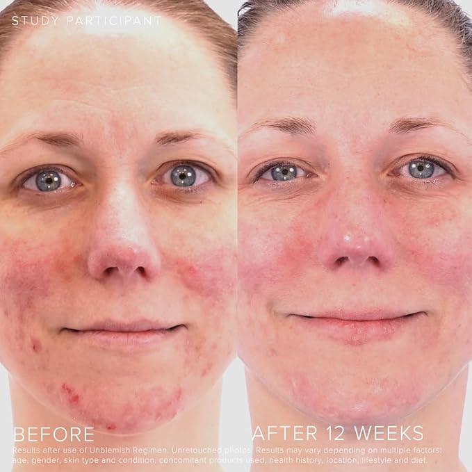 Rodan + Fields Unblemish Dual Intensive Acne Treatment | 0.76 Fl Oz | Targets Blemishes | Benzoyl Peroxide & Ceramides