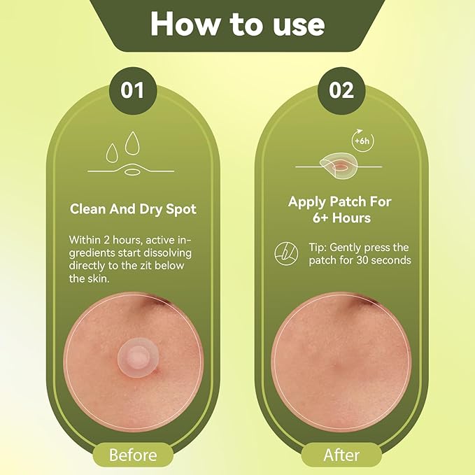 Microdart Hydrocolloid Acne Patch 24 Counts,Pimple Patch Hyaluronate Acid & Salicylic Acid Pimples Overnight for Deep, Early and Hidden Blemishes