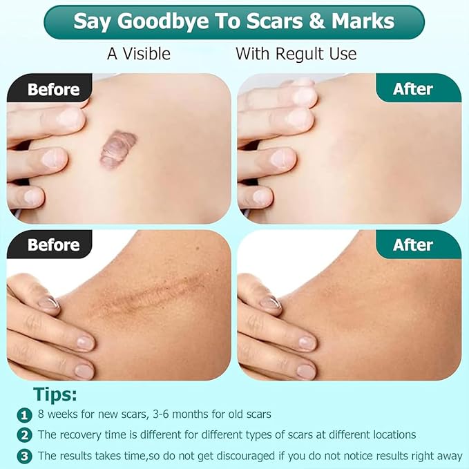 Advanced Scar Gel for Surgical Scars, Face, Body, Legs, Burns, Acne, C-Section, Stretch Marks, Keloids - Effective Scar Removal for Men and Women, Suitable for Old & New Scars (100% New -1 Bottle)