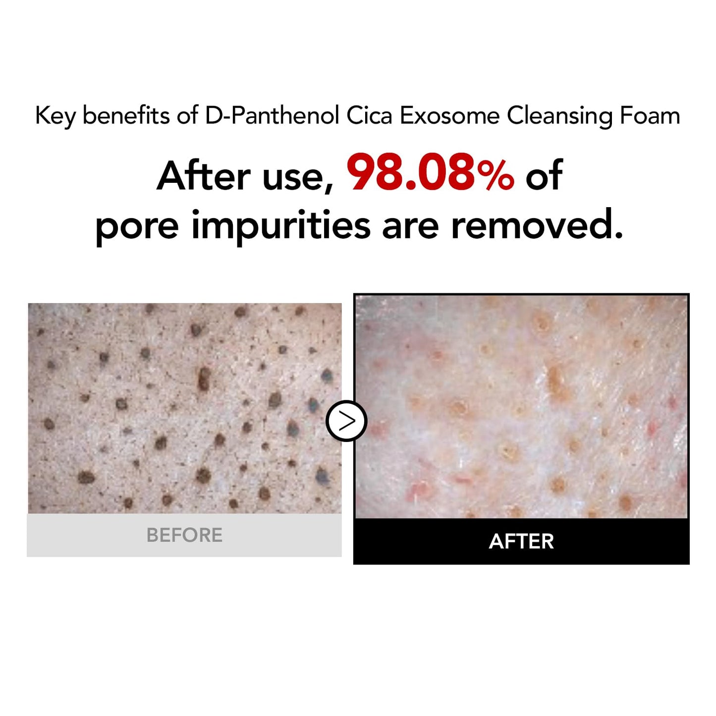 KIOSKIN 98% Reduction in Pore Impurities & 92% Less Sebum – Improves Blackheads & Whiteheads by 36% – Soothes & Strengthens Skin Barrier with D-Panthenol – Korean Skincare Best Cleansing Foam