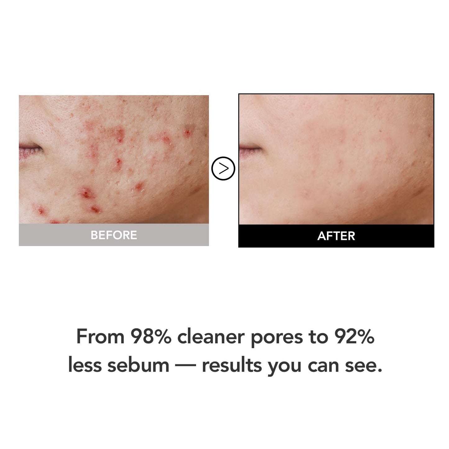 KIOSKIN 98% Reduction in Pore Impurities & 92% Less Sebum – Improves Blackheads & Whiteheads by 36% – Soothes & Strengthens Skin Barrier with D-Panthenol – Korean Skincare Best Cleansing Foam