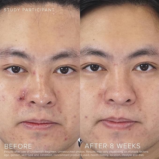 Rodan + Fields Unblemish Dual Intensive Acne Treatment | 0.76 Fl Oz | Targets Blemishes | Benzoyl Peroxide & Ceramides