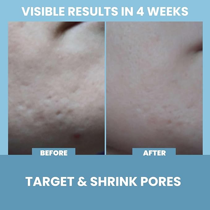 Eva Naturals Niacinamide 5% Serum for Face – B3 Pore Minimizer, Acne Treatment & Dark Spot Corrector with Hyaluronic Acid, Vitamin E, Aloe & Neem – Anti-Aging, Non-Greasy, Hydrating, 2oz