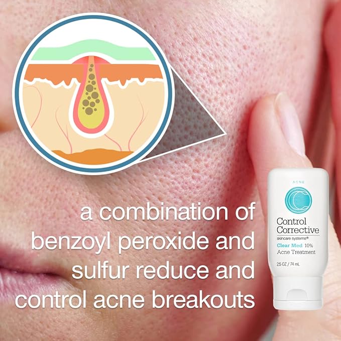 CONTROL CORRECTIVE Clear Med 10% Acne Treatment Lotion, 2.5 Oz - Helps Clear & Control Breakouts, Benzoyl Peroxide, 3% Sulfur To Improve Efficacy And Dry Up Blemishes