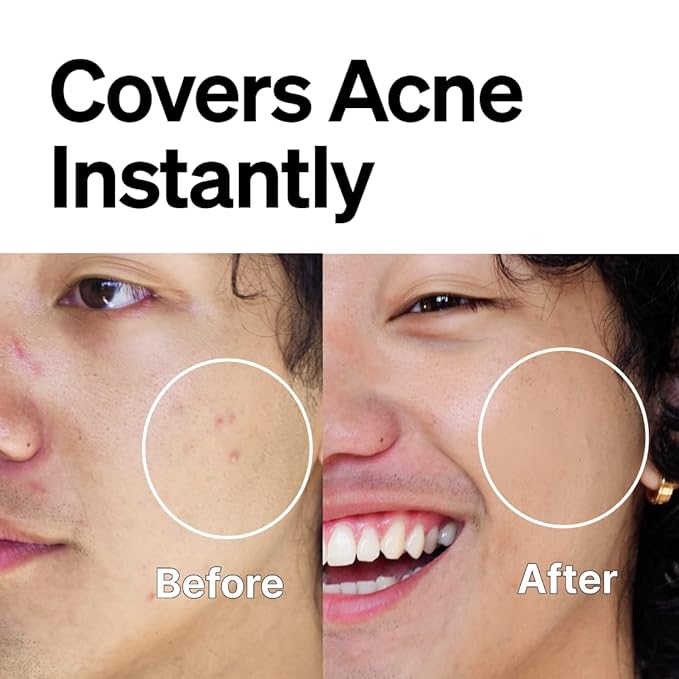 FRONTMAN Fade, Men's Acne Concealer With Salicylic Ac