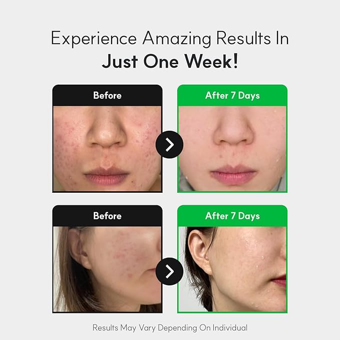 Centelsome 5X Soothing Cream 1.69 fl oz/50ml | Face Moisturizer for Skin Regeneration, Hydration, Blemish Spot Treatment, Korean Skincare, Centella Asiatica, Niacinamide, Exosomes, Panthenol