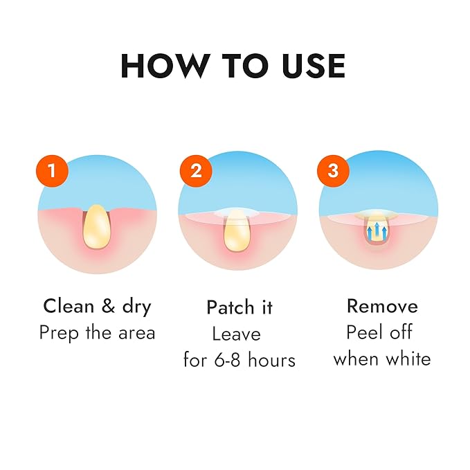 Epielle Over-Zit XL Acne Clear Patches | Ultimate Hydrocolloid Solution | 14 Extra-Large Pimple and Blemish Patches