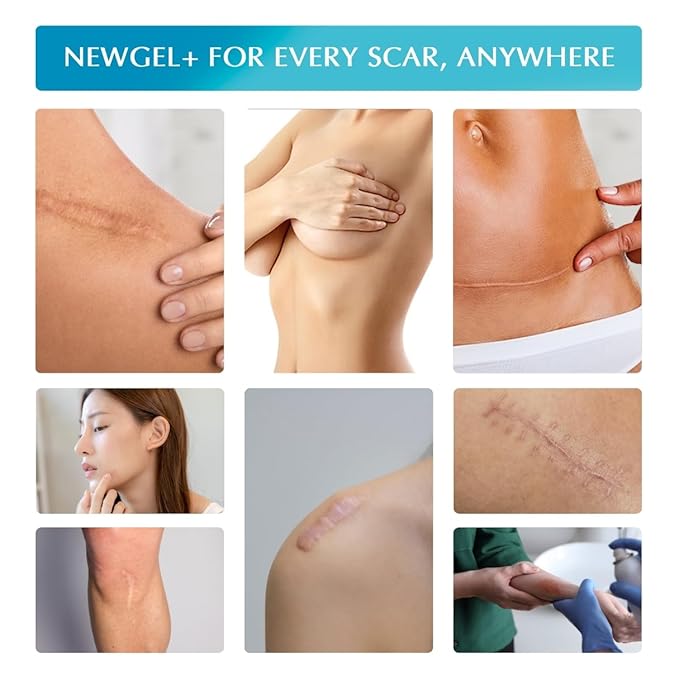 Advanced Silicone Scar Treatment Sheets for OLD, NEW Scars, Surgery, Keloids, C-Section, Burns, by NewGel Plus by MyNewGel, 1" x 6" Sheet (4 Count) - BEIGE