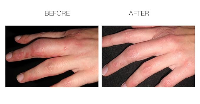 Elite Advanced Scar Treatment, Scar Removal, Scar Therapy, Scar Prevention, Anti Scar Gel with Silicone & Vitamin C -15g