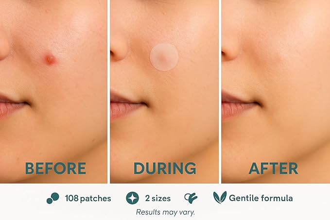 Klari Pimple Dots – 108 Hydrocolloid Acne Patches, Zit Stickers for Breakouts & Blemishes, Invisible Day & Night Spot Treatment for Face (2 Sizes)