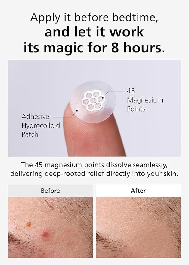 EasyDerm Micro Point Acne Patch Duo – 10 Magnesium Pimple Patches + 6 Real Calming Microdart Patches for Breakout & Post-Blemish Care, 2-Step K-Beauty Skincare Kit