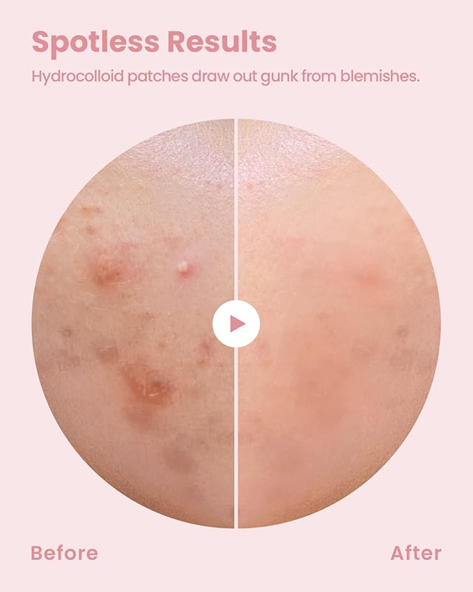 GLAM UP Hydrocolloid Blemish Pimple Zit Patches(180PCS/2Size) - Invisible Ultra Thin Spot Cover Stickers for Face and Skin, Strong Water-proof and Adhesive Overnight, Vegan-friendly