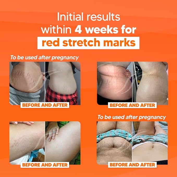 Cicatrissim Deep Stretch Mark Removal Cream