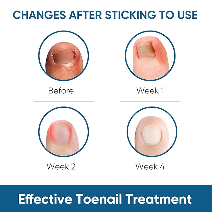 Ingrown Toenail Treatment, 60Pcs Ingrown Toenail