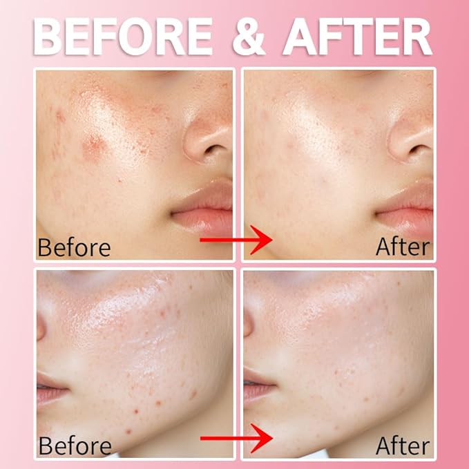 Purederm Blemish Spot Treatment Gel with Salicylic Acid 2%, Soothing Acne Care for Irritated Skin, Day & Night Use, 20ml