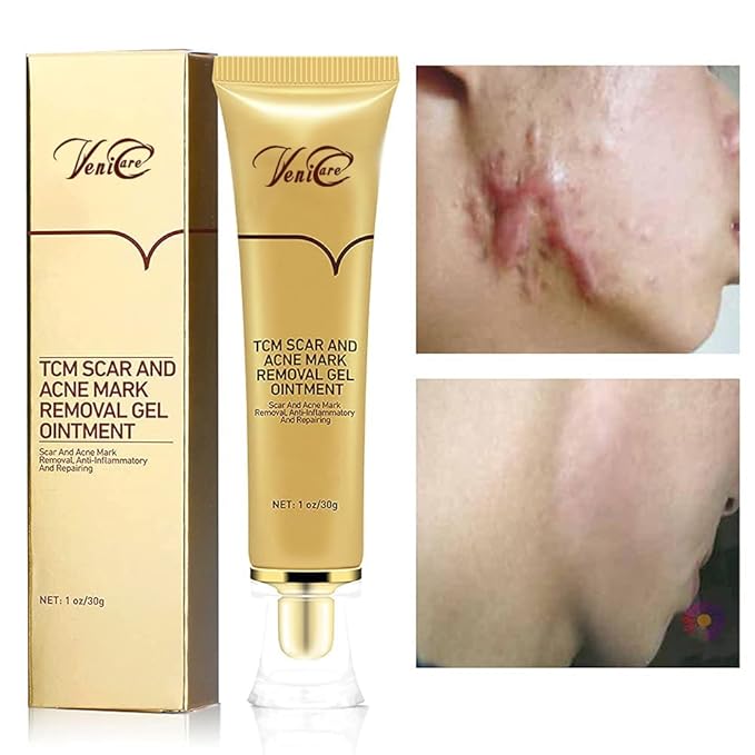 Acne Scar Removal Cream Stretch Marks (Packaging