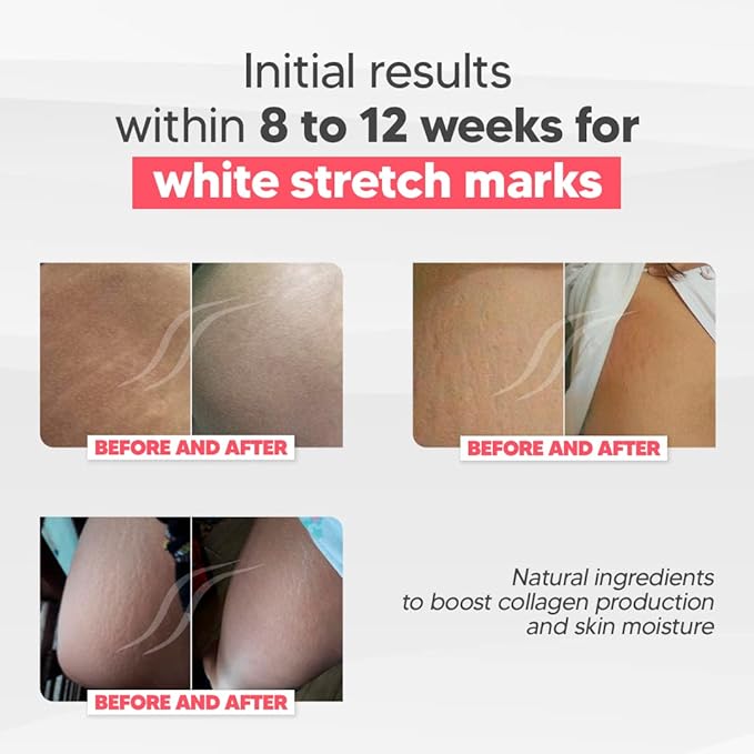 Cicatrissim White Stretch Mark Fade and