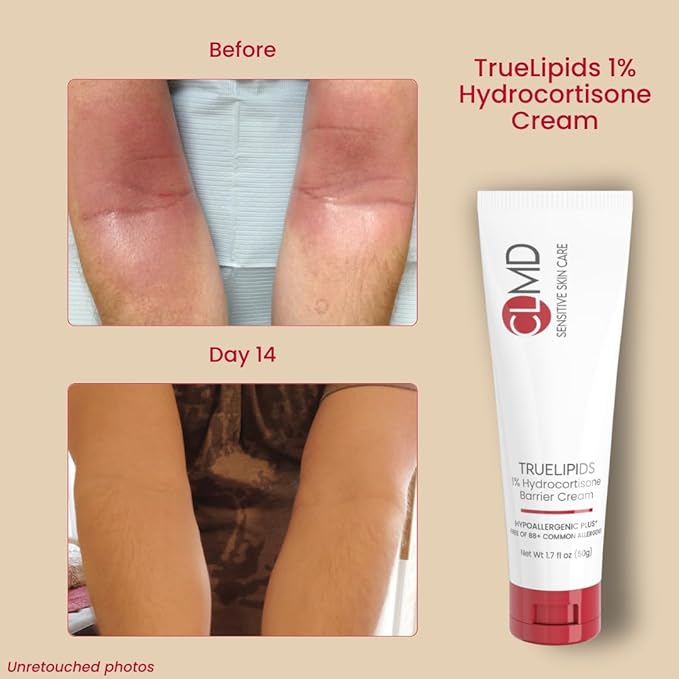 CLMD Hydrocortisone Barrier Cream – 1% Hydrocortisone for Eczema & Itch Relief – Soothes Dry, Cracked Skin, Restores Skin Barrier – Dermatologist Tested – 1.7 fl oz