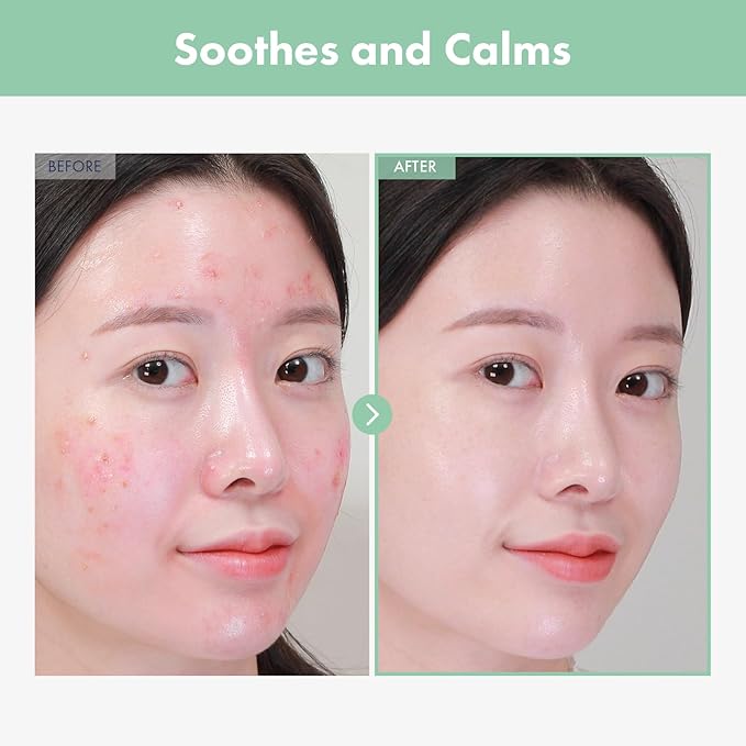 NATUREONE AC Kill Cream, BHA & Salicylic Acid Face Moisturizer, Niacinamide for Active Skin Repair, Tea Tree Oil for Soothing Sensitive Skin, acne spot treatment Korean Skincare, 30g, 1.05 oz.