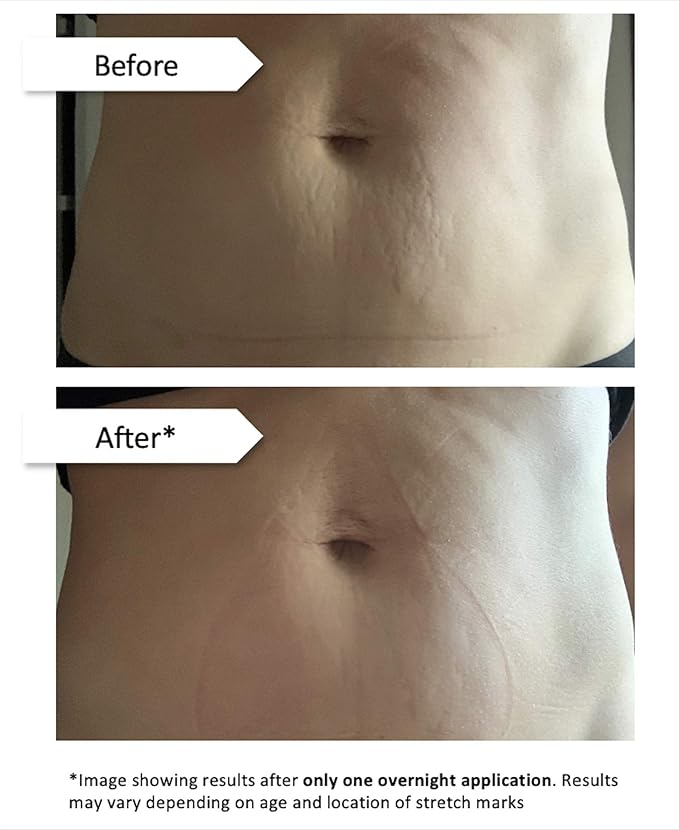 Stretch Mark Eraser | Overnight Stretch