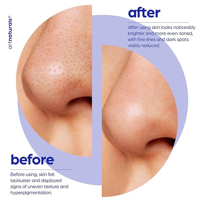 artnaturals Glycolic Serum - Face Serum - Vitamin C and Aloe Vera - Exfoliates and Minimizes Pores, Reduce Acne, Breakouts, and Appearance of Aging and Scars -1 oz.