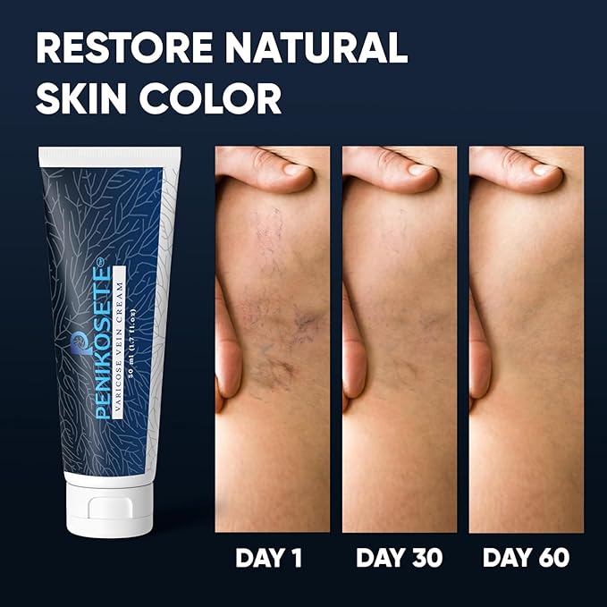 Varicose Veins Treatment | Natural Ayurvedic Cream for Legs with Ashwagandha | Spider Vein Removal Cream for Improved Circulation & Relief from Heavy Fatigued Legs | Non-Sticky