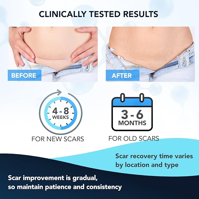 Silicone Scar Gel: Silicone Gel for Scars - Improve Scar Appearance for Old and New Scars - Medical Grade Silicone - Advanced Scar Gel - Scalds - Surgery - Injury - Stitches - Burns - 20g