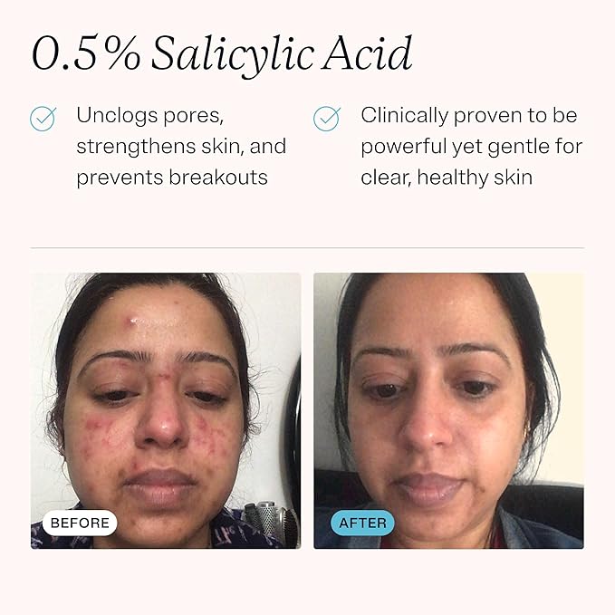 MDacne Hydrating Facial Cleanser with Salicylic Acid 0.5% - Acne Treatment with Plant-Based Ingredients to Remove Dirt & Oil, Protect Skin & Unclog Pores (2 Ounce (Pack of 1))