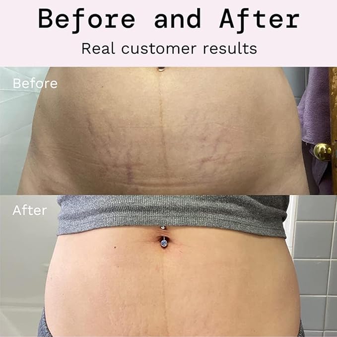 Stretch Mark Prevention Cream for Pregnancy,