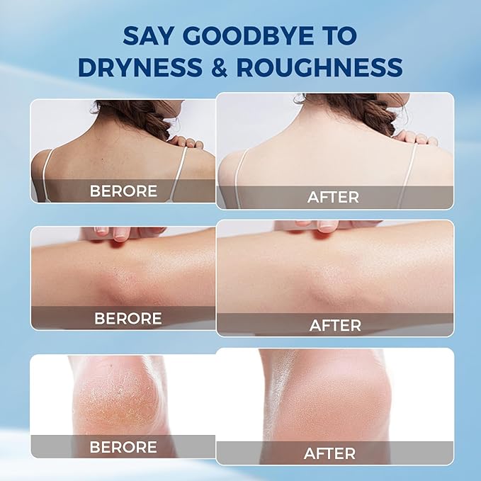 OUKEYA NEW FORMULA Urea Cream 40 Percent for Feet Maximum Strength, Hand Heels Dry Cracked Treatment Lotion for Knees & Elbows, Foot Dead Skin Cuticle Callus Remover Toenail Softener, 5.29 oz