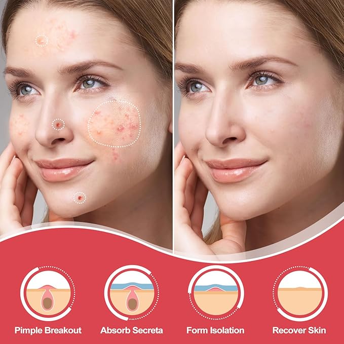 216 Counts Pimple Patches for Face, Hydrocolloid Acne Patches Zit Patches for Face Acne Spot Treatment Patch Cystic Acne Treatment Stickers Blemish Hydrocolloid Cover for all Skin Type