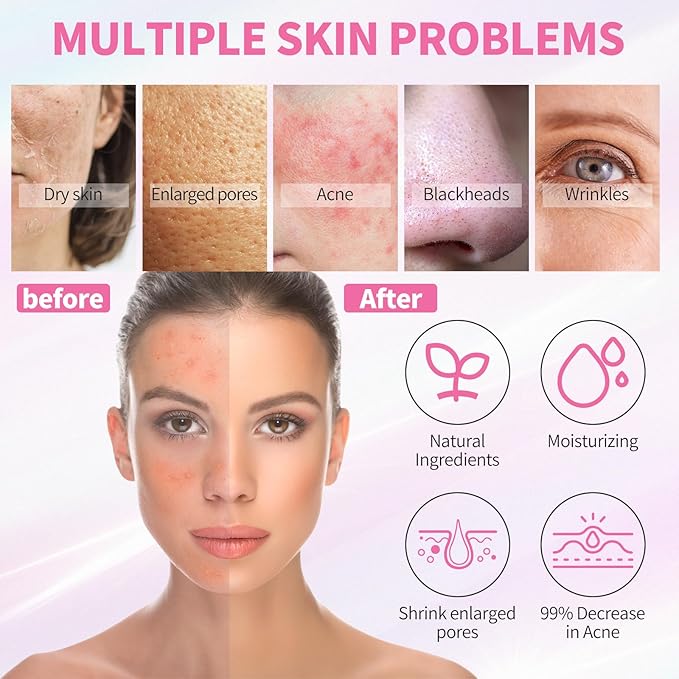 5 Step Skincare Kit with Cleanser, Face Scrub, Clay Mask,Toner & Acne Serum for Teens and Adults