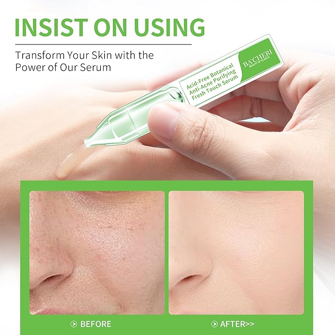 Gentle Botanical Acne Treatment for Face – Acid-Free Spot Facial Serum with Niacinamide & Witch Hazel, Soothes Redness & Controls Breakouts for Sensitive, Oily & Acne-Prone Skin – 1.2 ml × 30 Ampoules