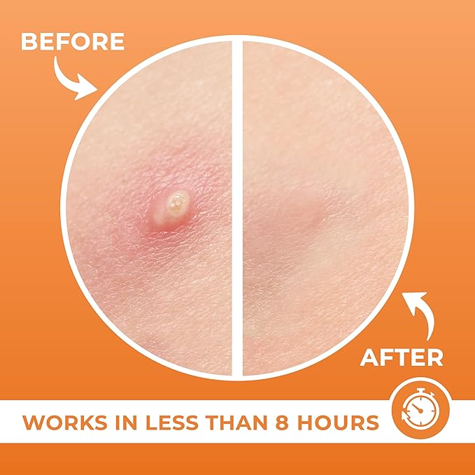 Acne Patches (120 Count) with Tea Tree Oil, Hydrocolloid Pimple Patches for Face - Zit Patch Acne Dots - Cystic Acne Patches Treatment - Pimple Patch with 3 Size Acne Stickers