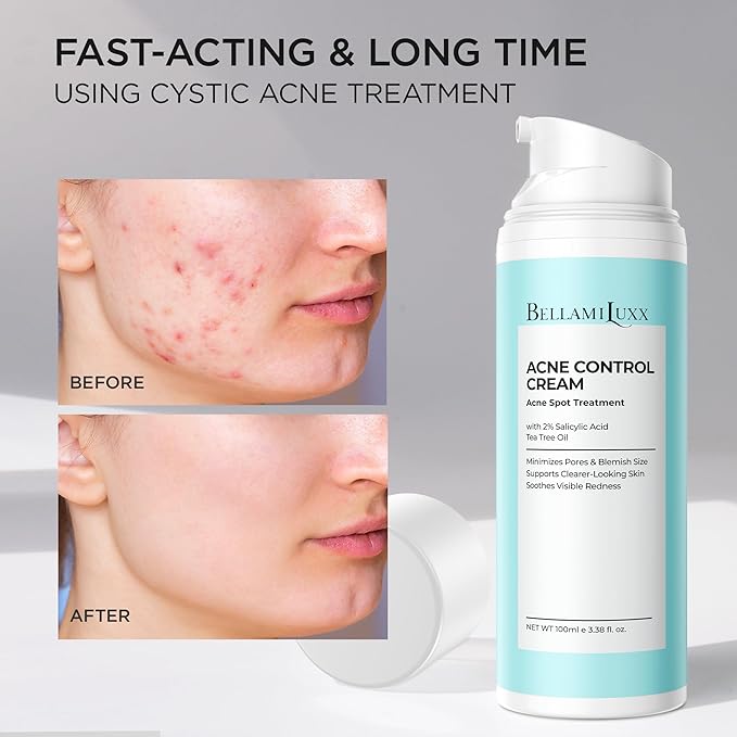Acne Treatment for Face: Cystic Acne Spot Control Cream with Salicylic Acid & Tea Tree Oil for Blemishes - Gentle Hormonal & Pimple Treatment for Teens & Adults - 120 Day Supply & 3.38oz