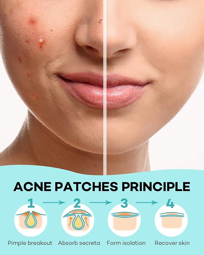 Pimple Patch Acne Patch, 4 Sizes 560 Patches Acne Absorbing Cover Patch, Hydrocolloid Invisible Acne Patches For Face Zit Patch Acne Dots Tea Tree, Calendula Oil - 4 Pack