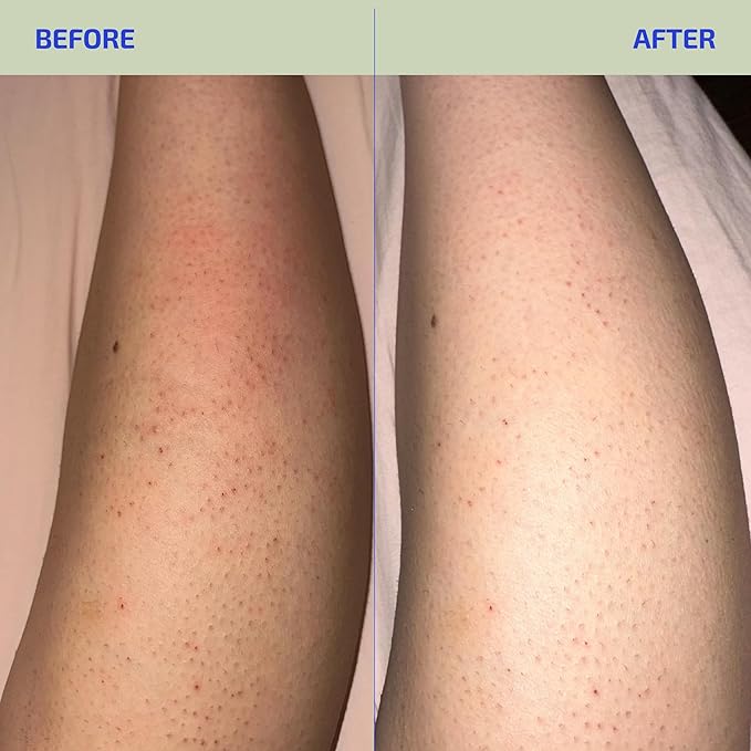 BIA Eczema Relief Lotion, 3.4 oz - Clinically Proven Colloidal Oatmeal 1% for Itchy Dry Eczema Prone Skin - Fragrance Free Moisturizer with BiaComplex 2.0 - Safe for Babies, Kids & Adults
