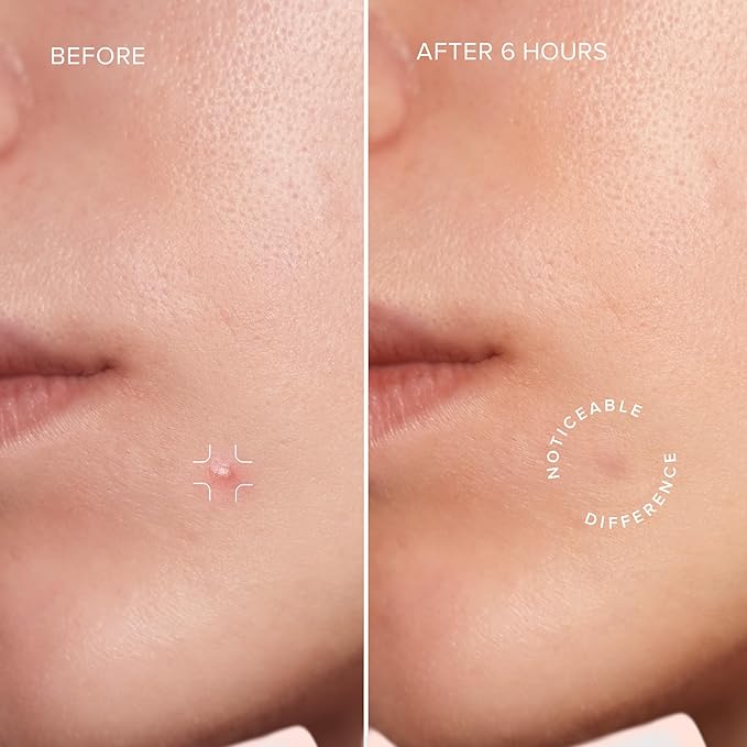 MAREE Star Pimple Patches for Face 2 PACK - Acne Patches - Natural Green Algae Extract & Tea Tree Oil - Hydrocolloid Stars Cute Zit Stickers, Parches Para Acne - Marine Collagen Blemish Pimple